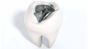 Servicios Tratamiento de restauración dental para reparar caries y dientes dañados