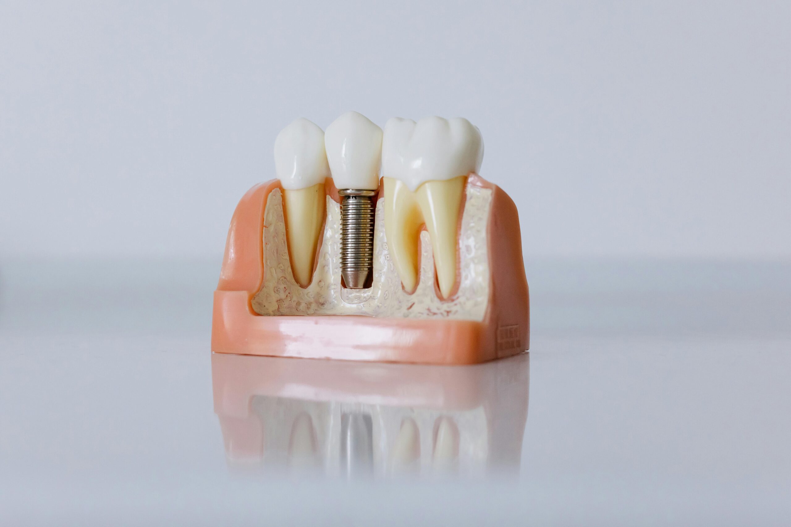 Servicios Paciente recibiendo implante dental en clínica odontológica en Zipaquirá