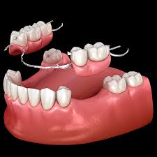 Servicios Prótesis dental para reemplazar múltiples dientes perdidos en clínica odontológica