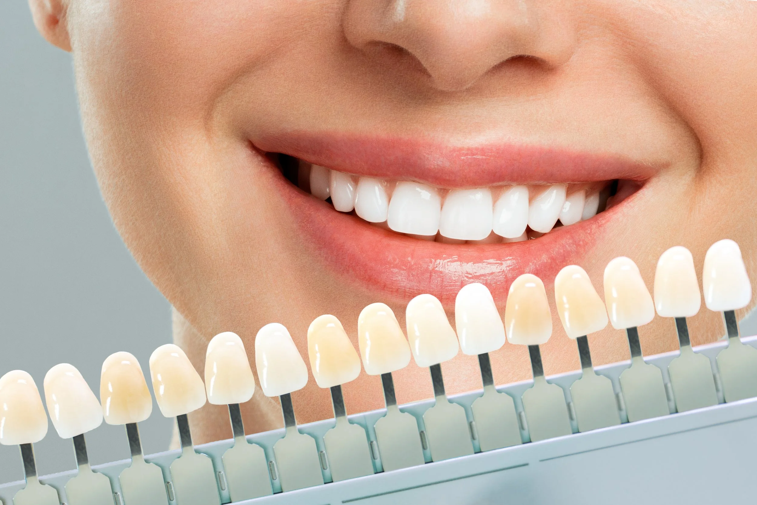 Servicios Mujer sonriendo después de un blanqueamiento dental profesional en Zipaquirá