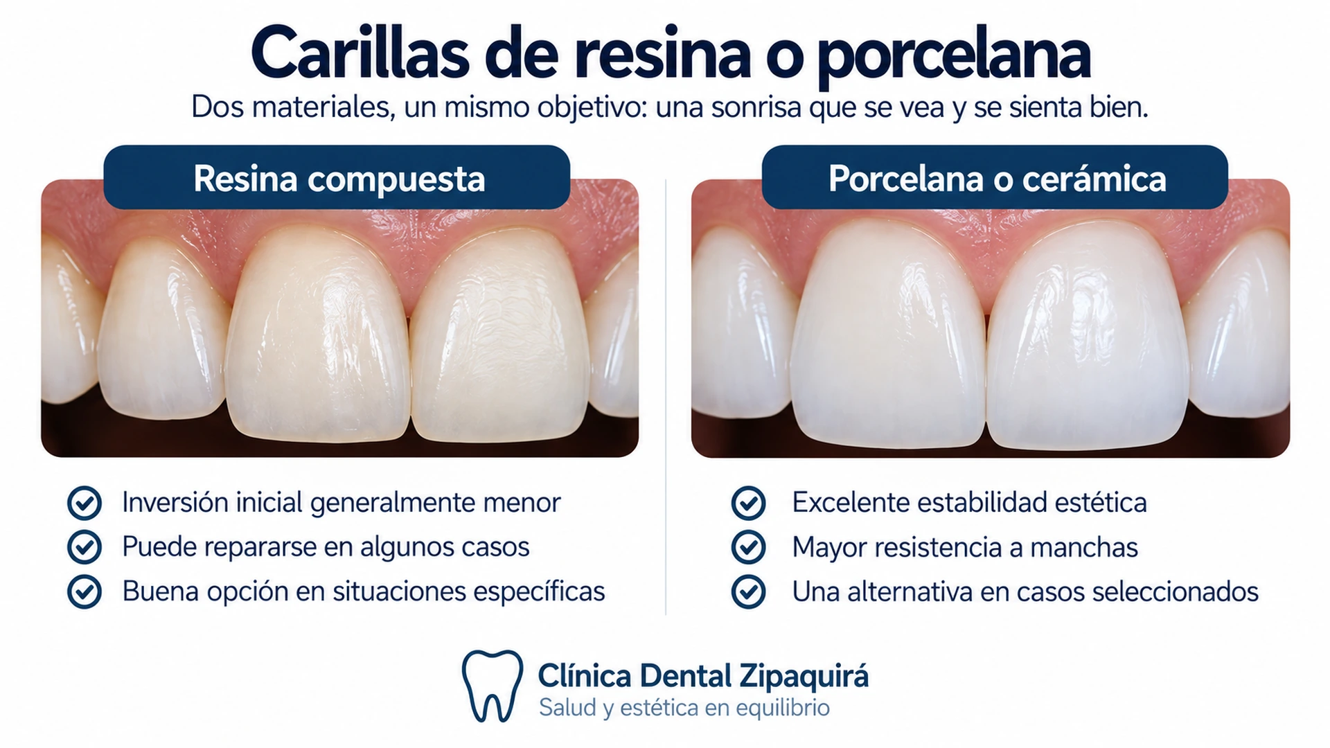 Comparación visual entre carillas de resina compuesta y carillas de porcelana o cerámica