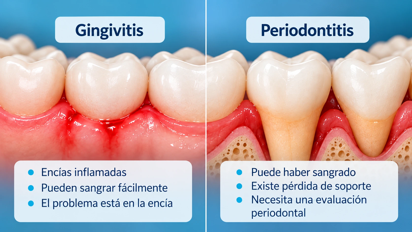 Comparación educativa entre encía inflamada y pérdida de soporte asociada con periodontitis
