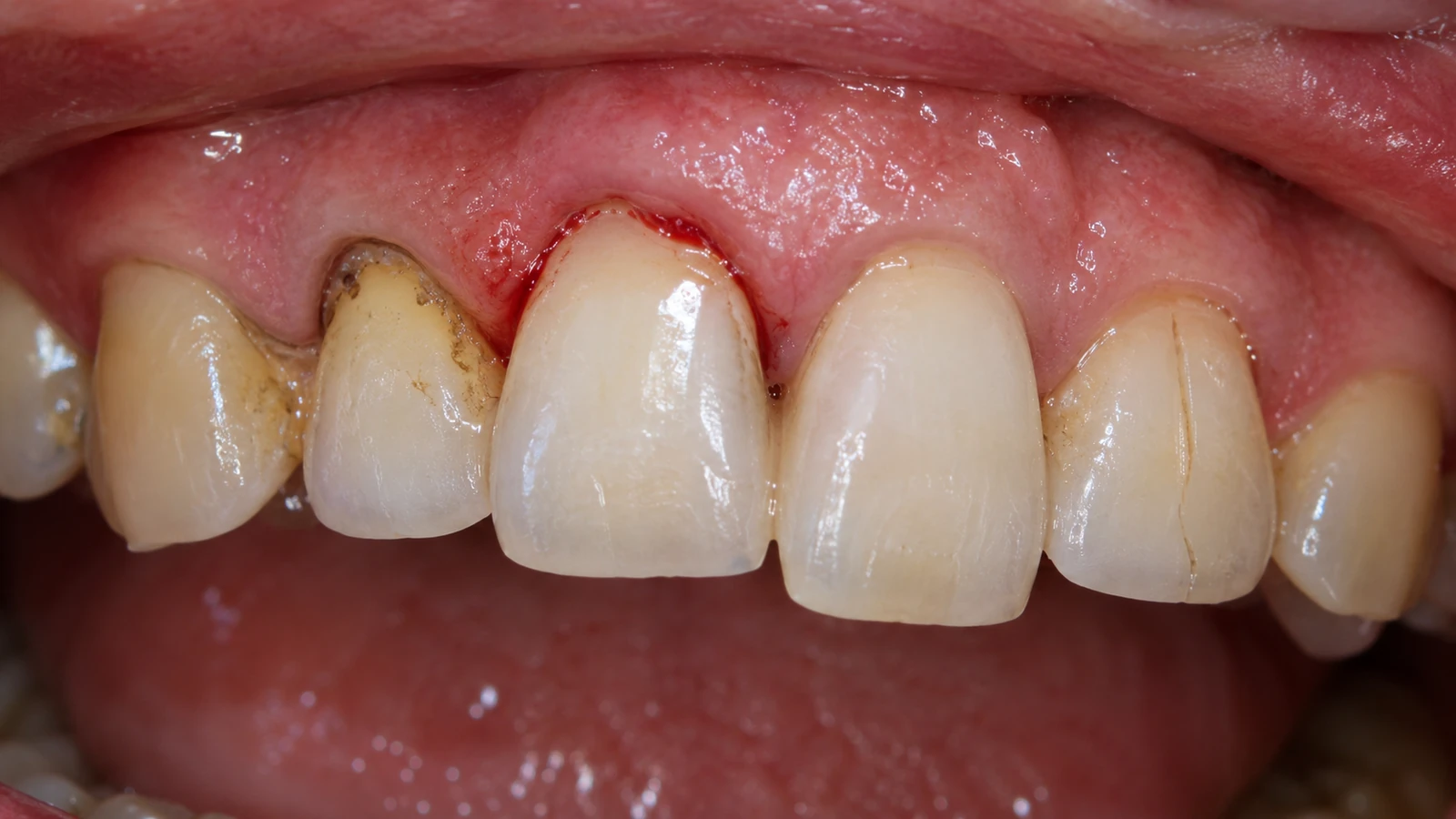 Primer plano dental con cambios visibles en encía y dientes que requieren evaluación periodontal